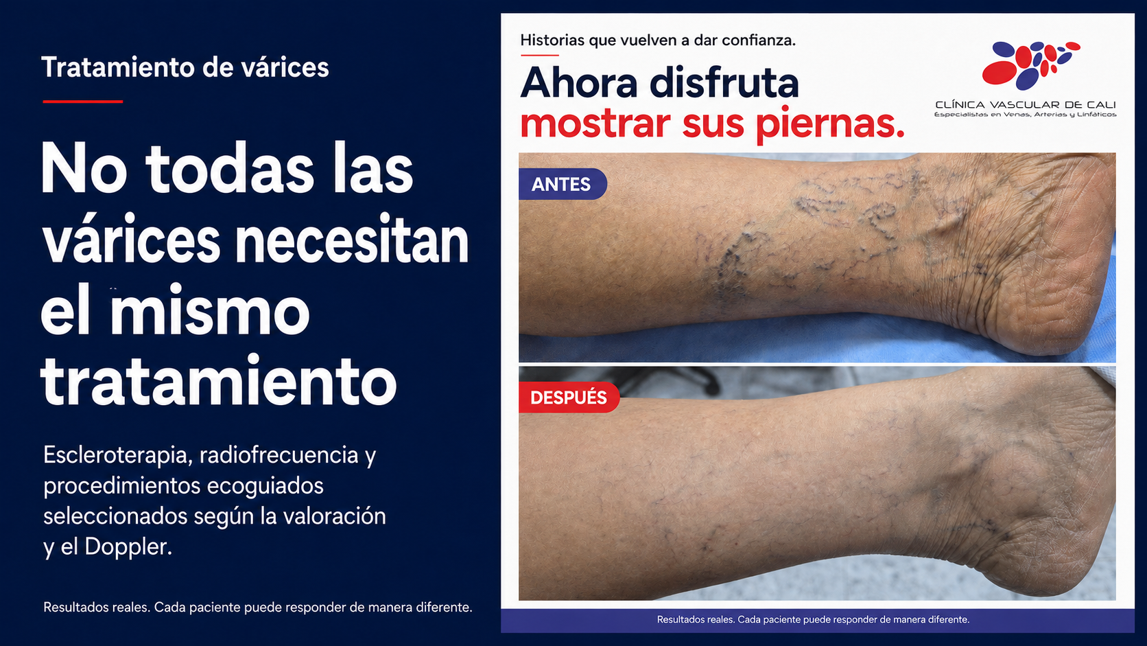 Tratamiento de várices con escleroterapia y procedimientos ecoguiados