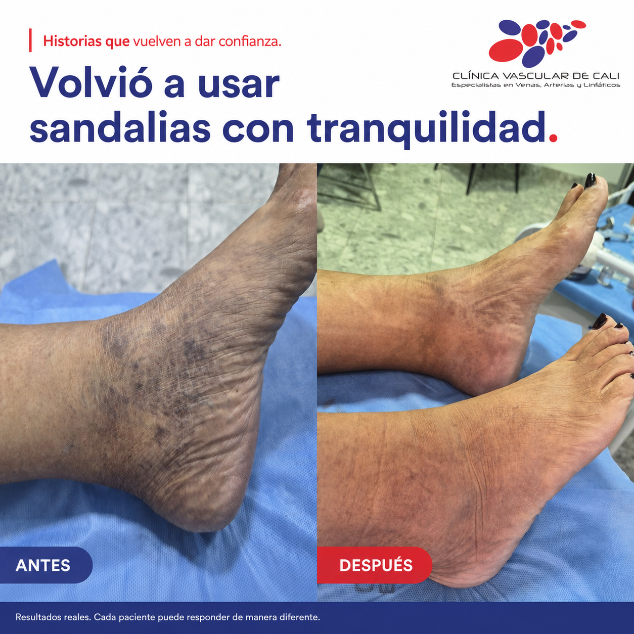 Caso real de escleroterapia antes y después en pie.