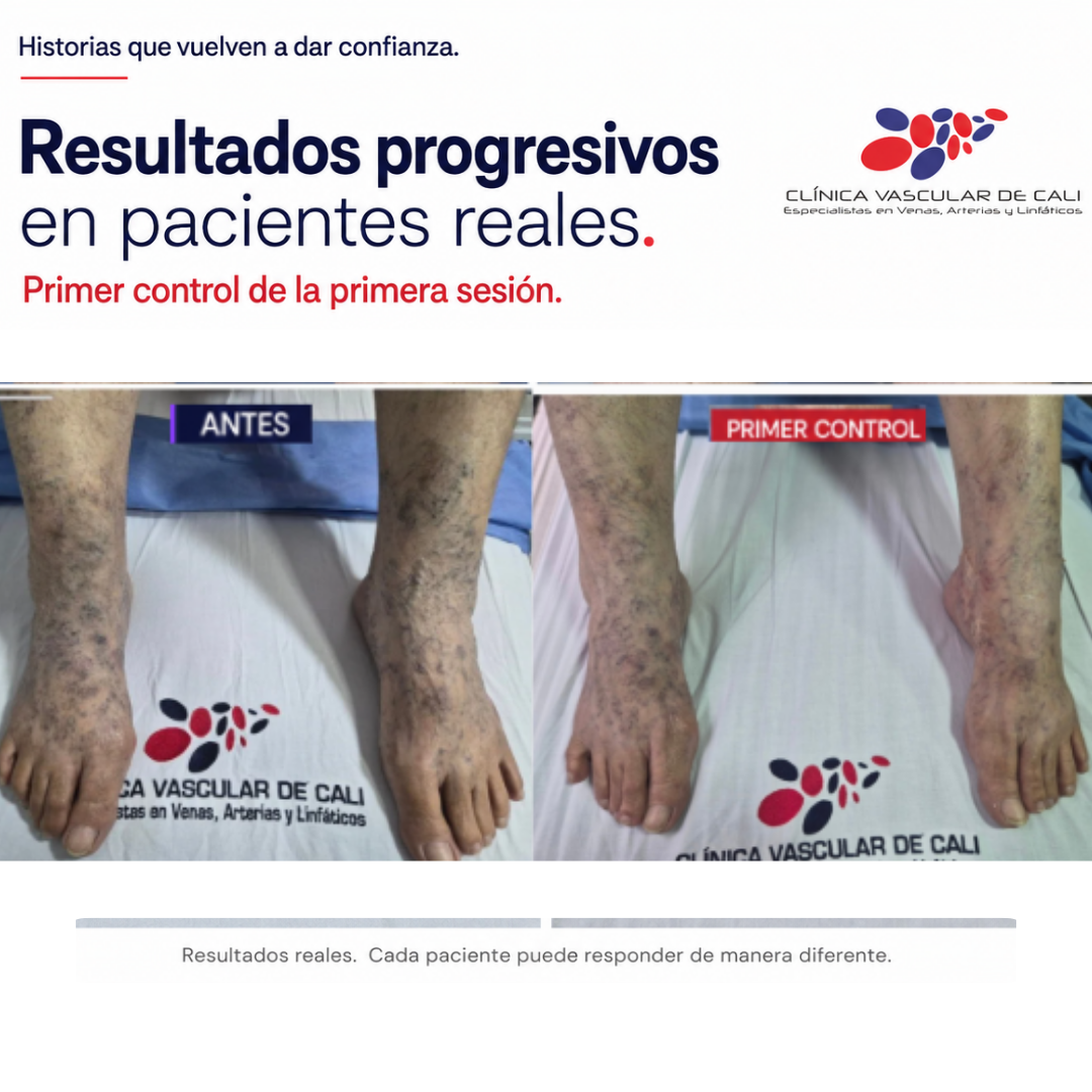 Caso real de escleroterapia con reducción visible de venas.