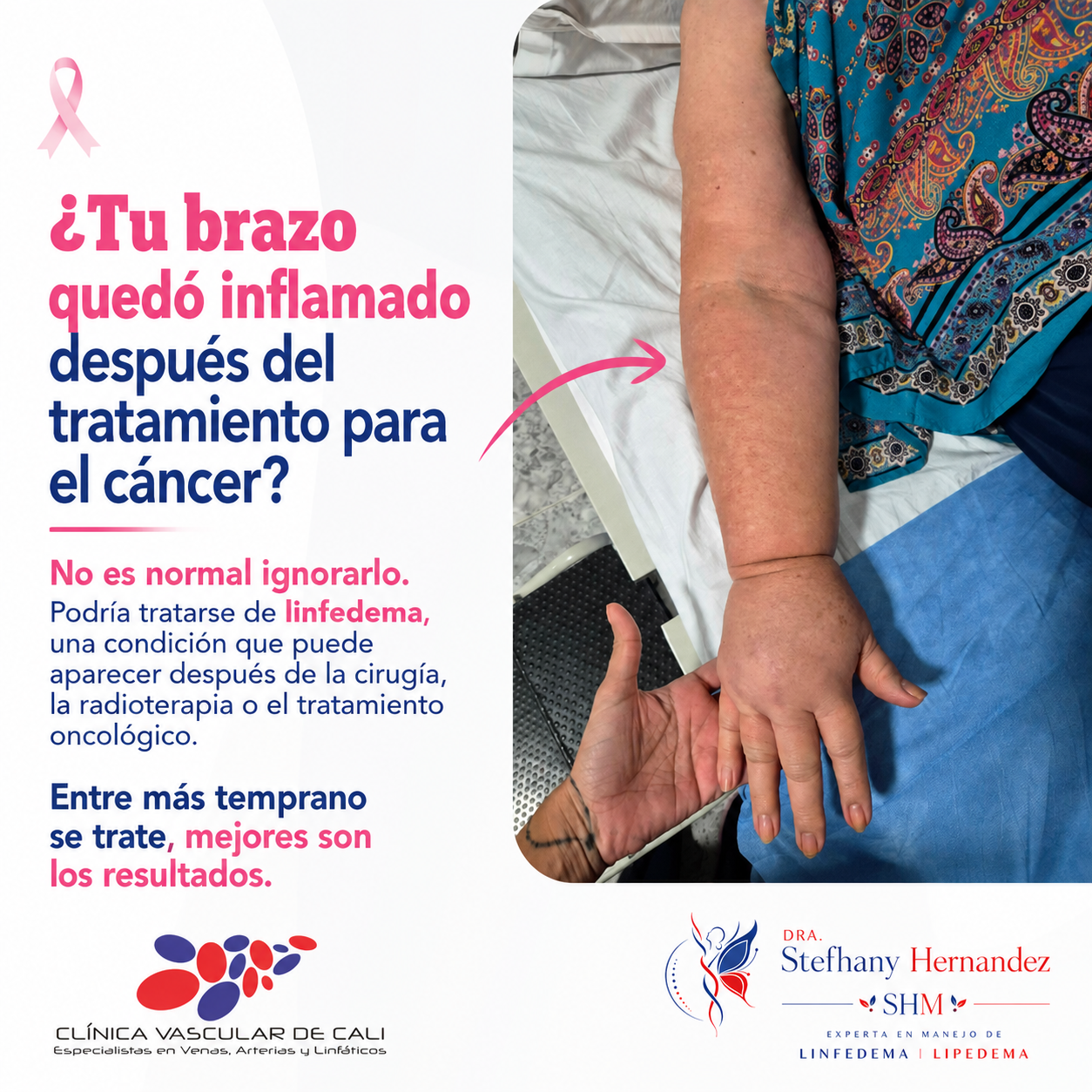 Caso real de linfedema con reducción de volumen del brazo.