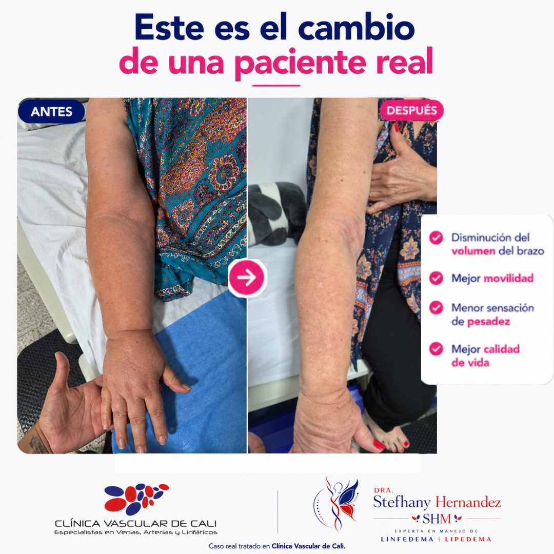 Pieza informativa sobre señales de linfedema y tratamiento oportuno.