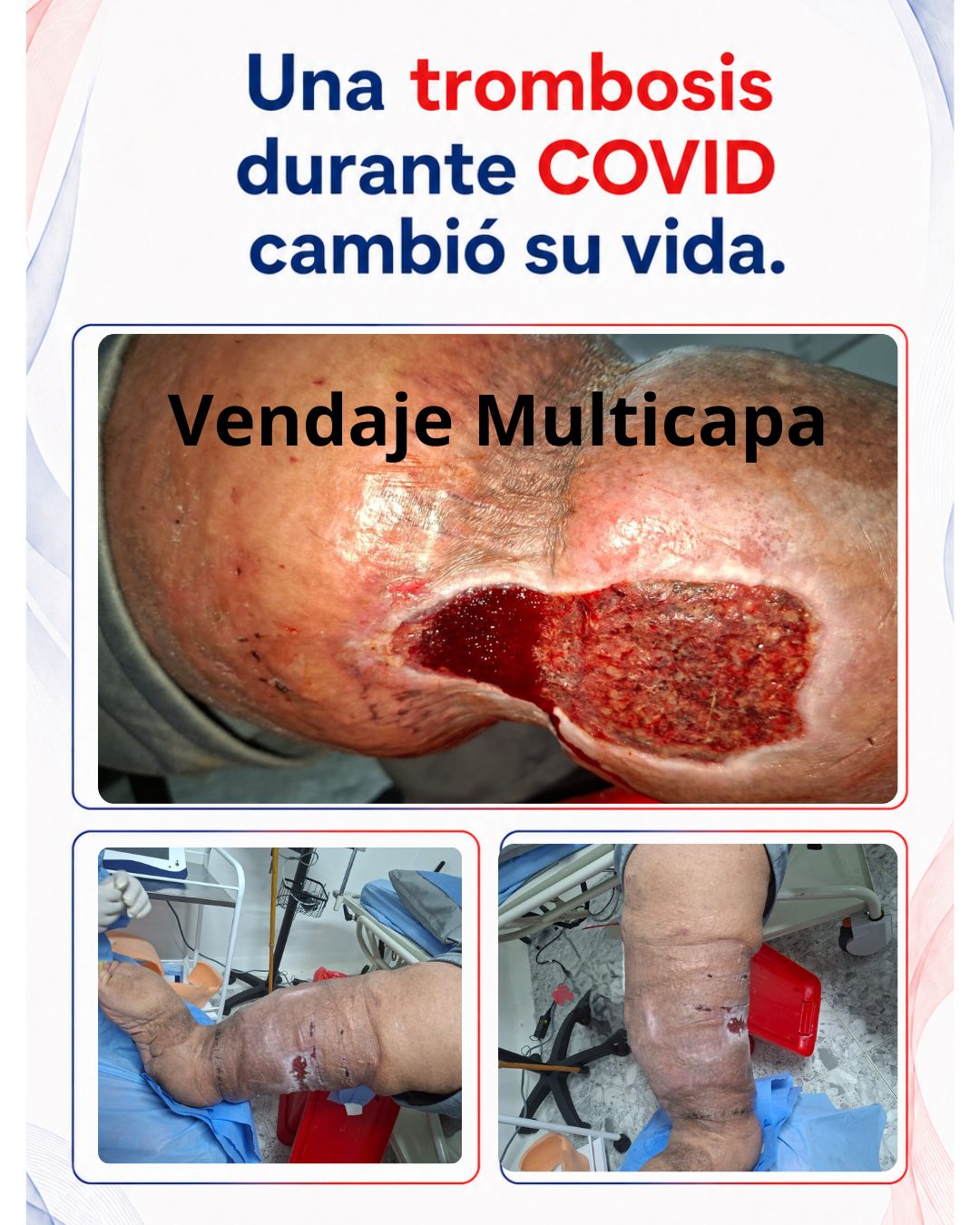 Caso clínico de paciente con vendaje multicapa.