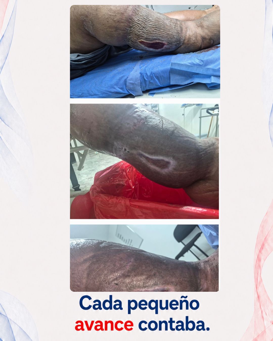 Seguimiento de paciente durante tratamiento con vendaje multicapa.