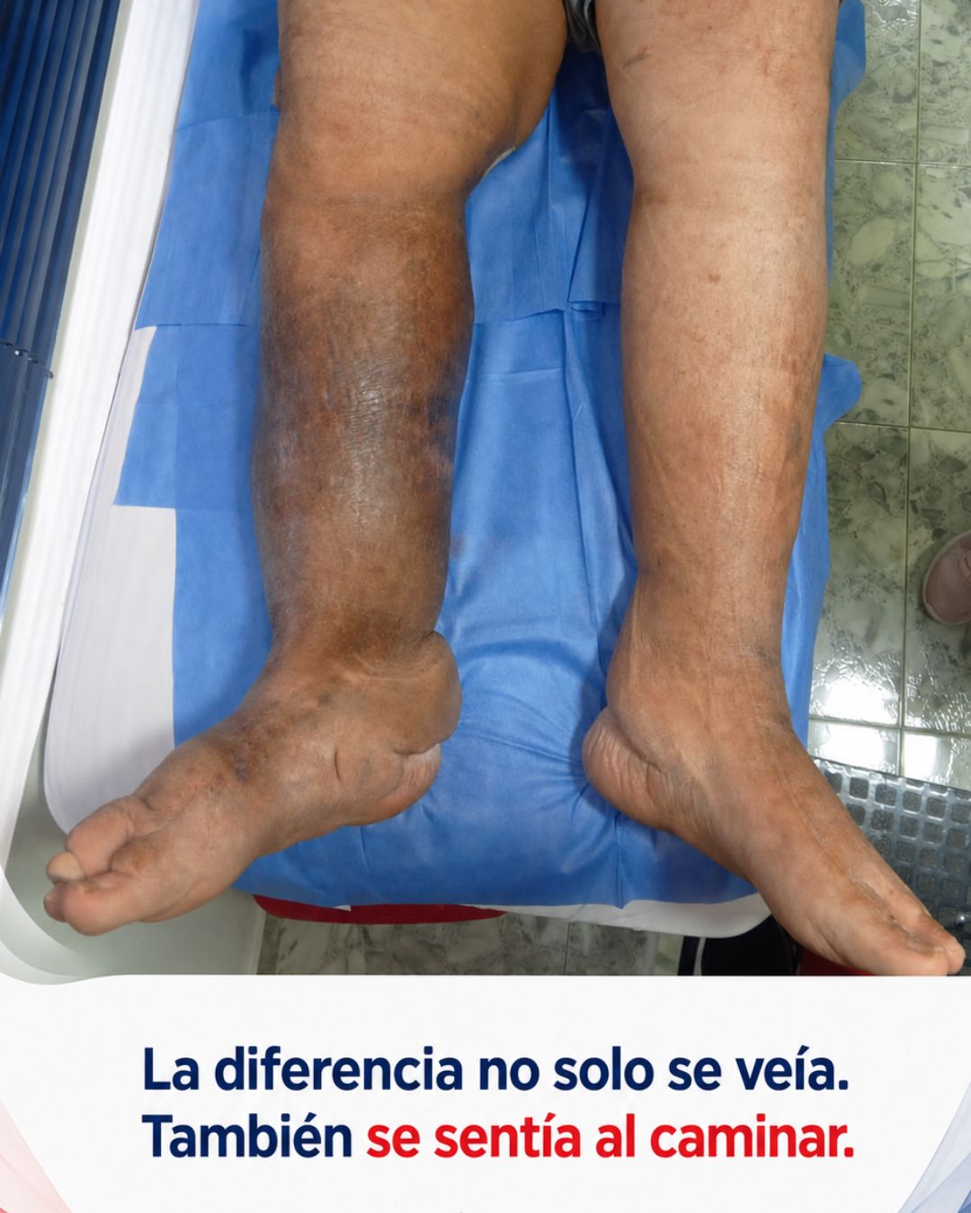 Evolución clínica de paciente después del tratamiento con vendaje multicapa.
